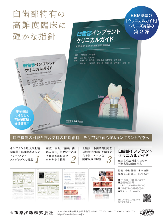 臼歯部インプラントクリニカルガイド