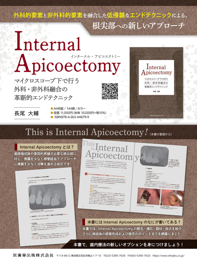 Internal Apicoectomy