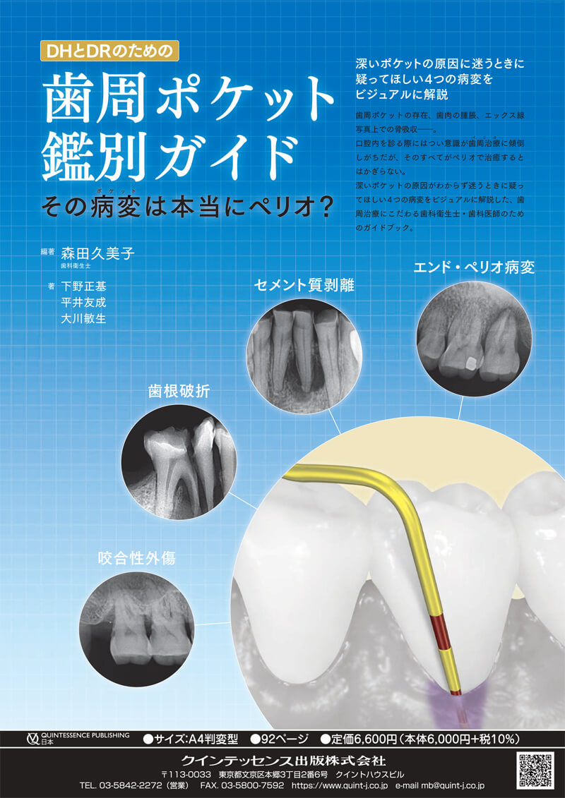 DHとDRのための歯周ポケット鑑別ガイド